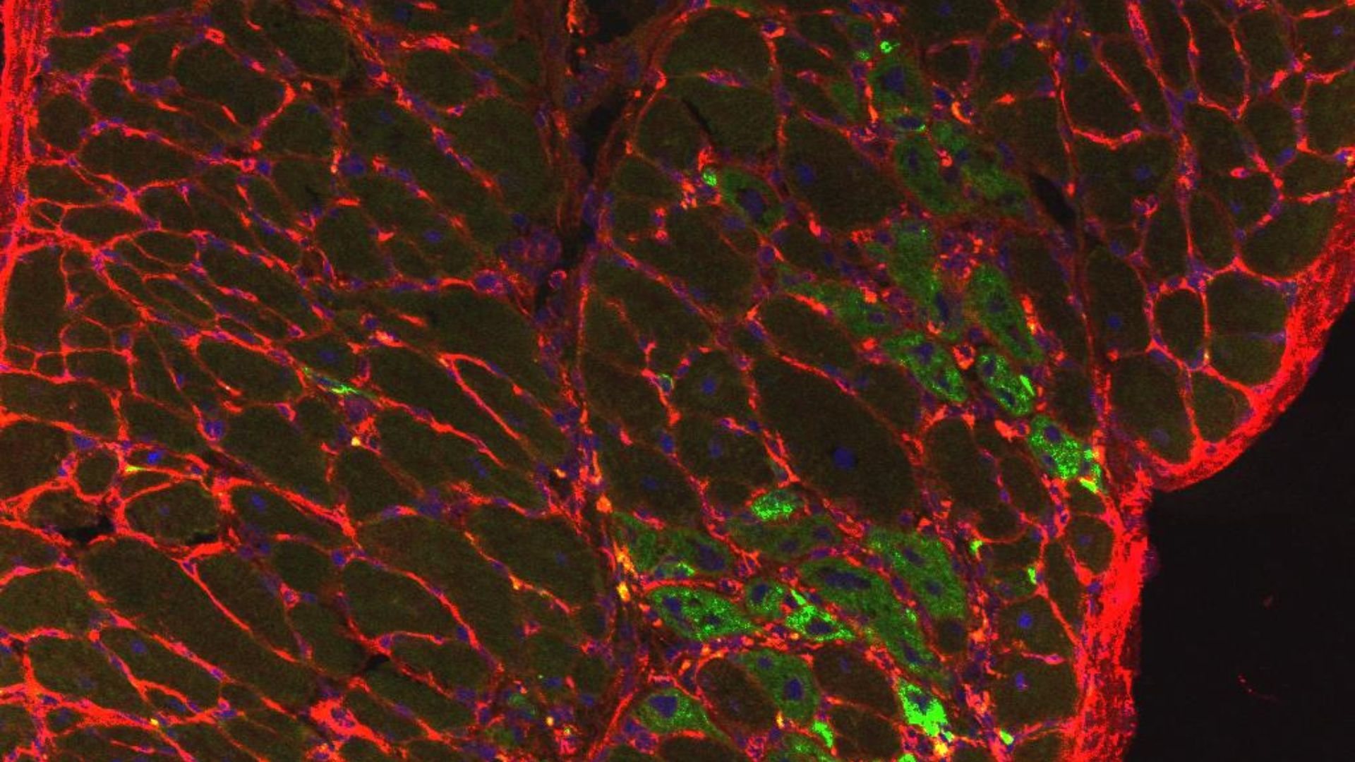 File:Duchenne Muscular Dystrophy (35122690776).jpg