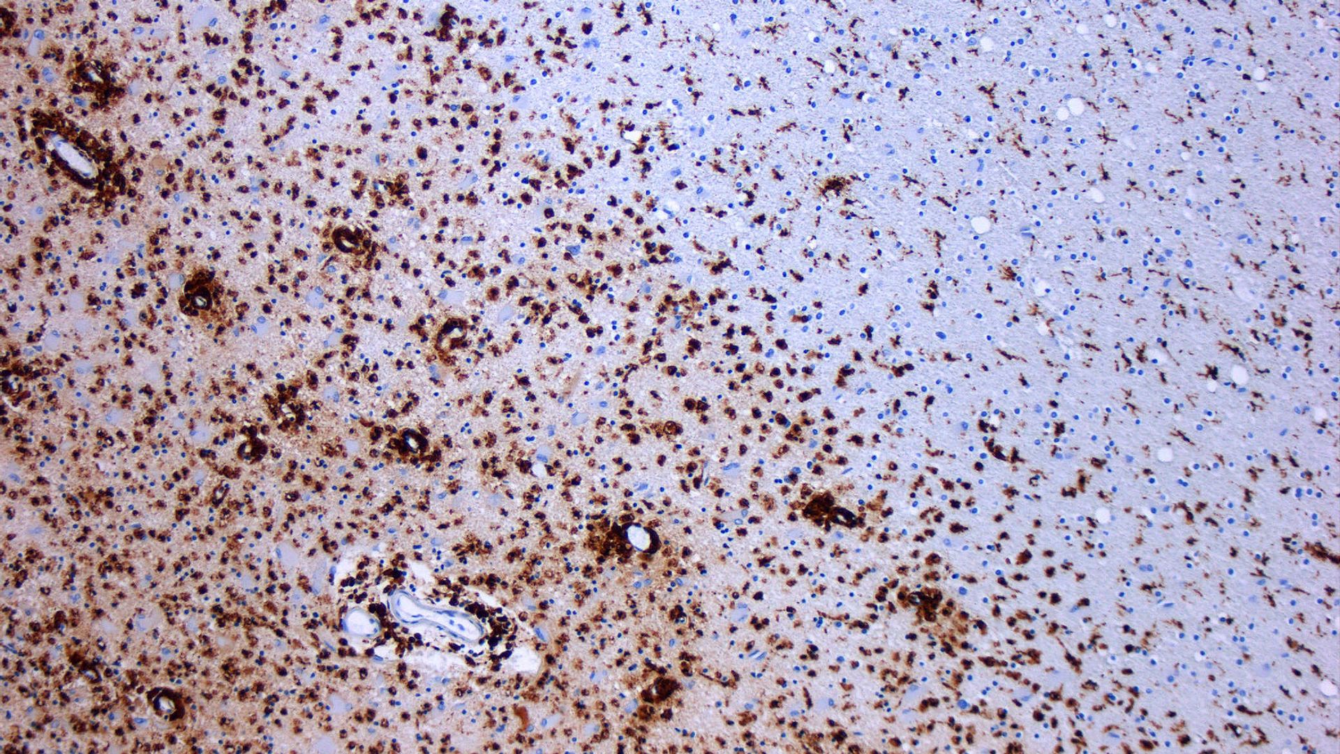 File:MS Demyelinisation CD68 10xv2.jpg