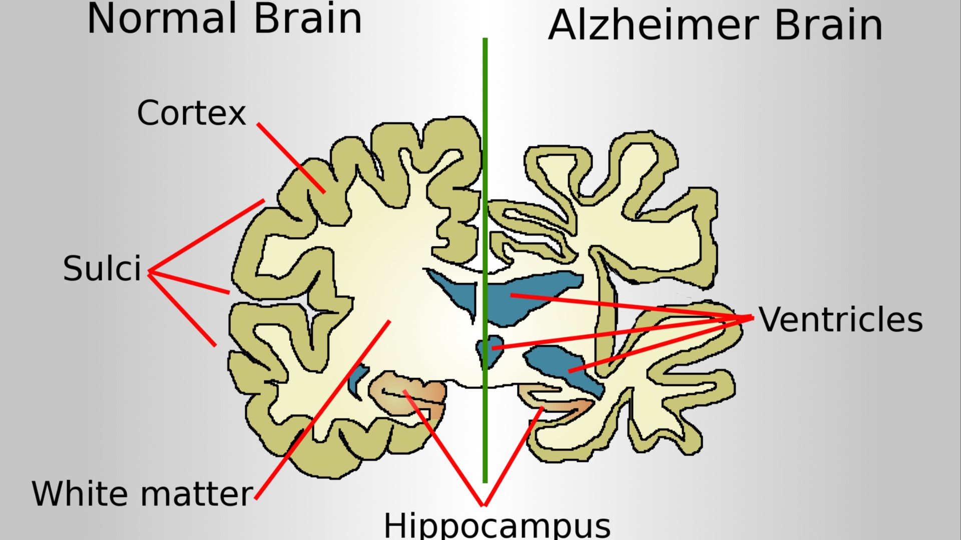 File:Brain-ALZH.png