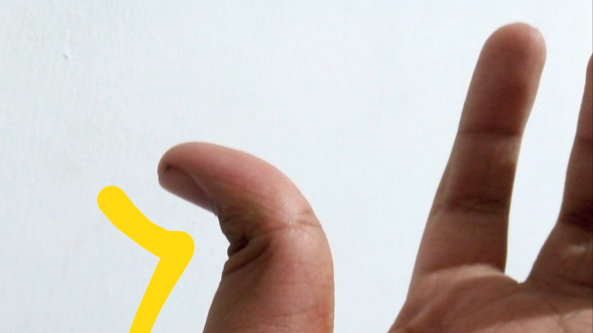 File:Z-shaped deformity.jpg