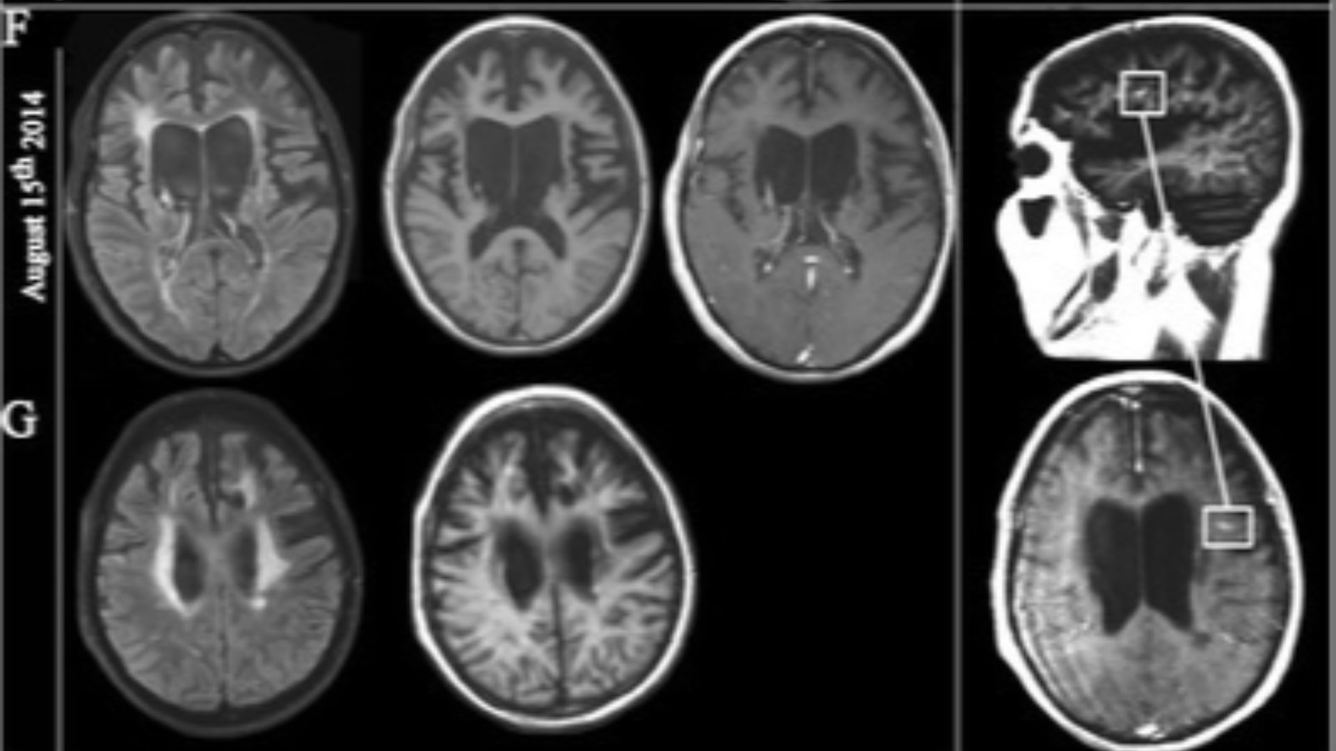 File:Acute hemorrhagic Leukoencephalitis in a patient with Multiple sclerosis (MRI).png