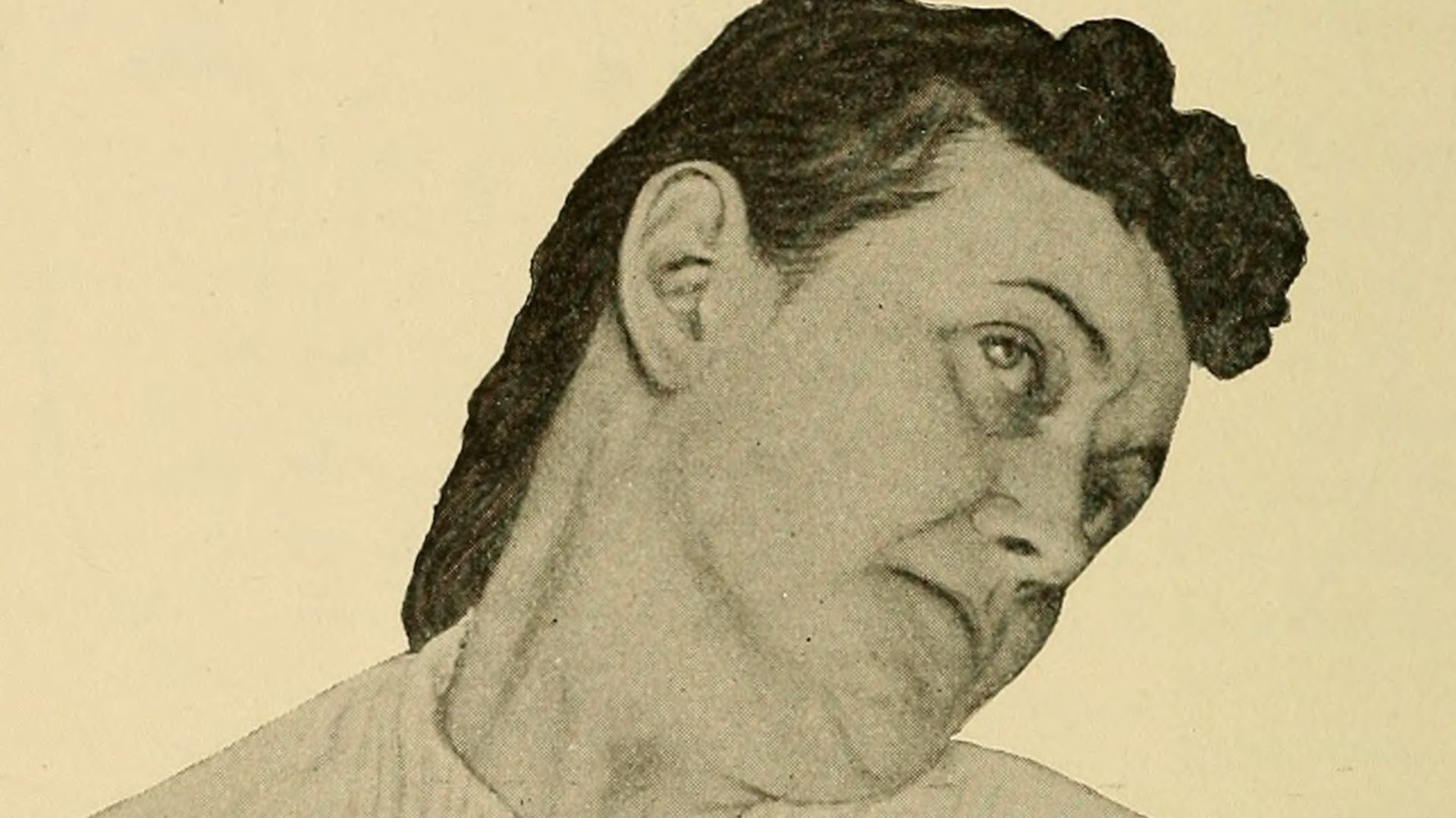 File:Hysterical torticollis.jpg