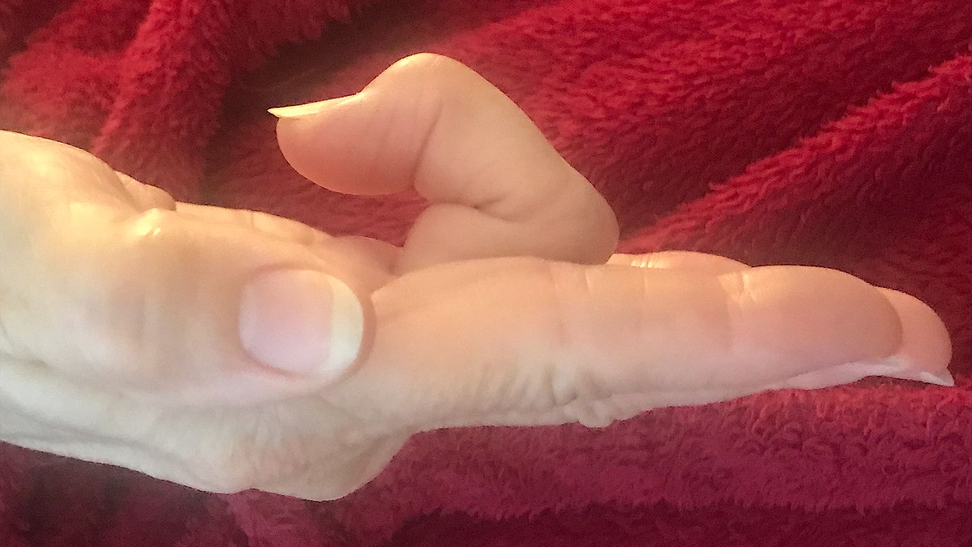 File:20230326 Trigger finger - right middle finger.jpg