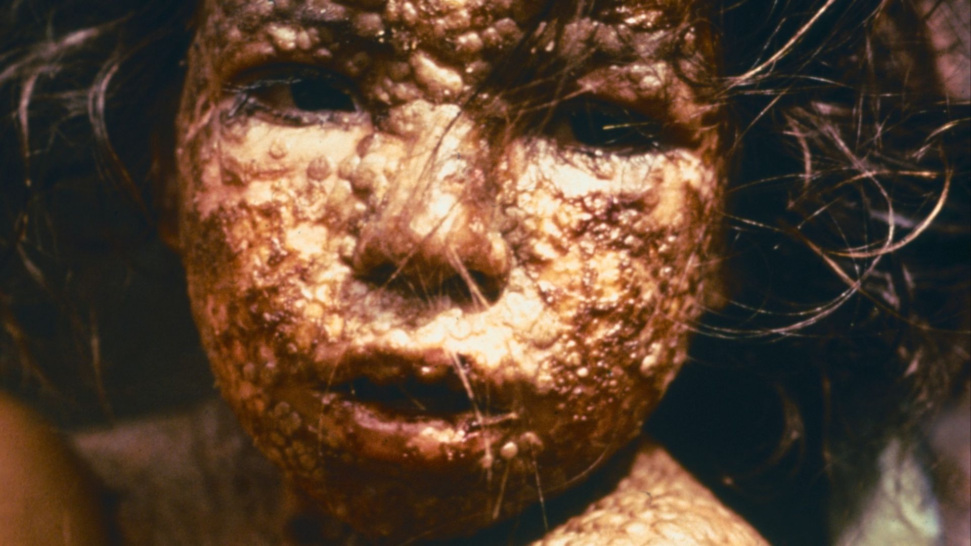 Smallpox In Kids 10 Diseases That Are A Thing Of The Past & 10 That Are Still Threats ...