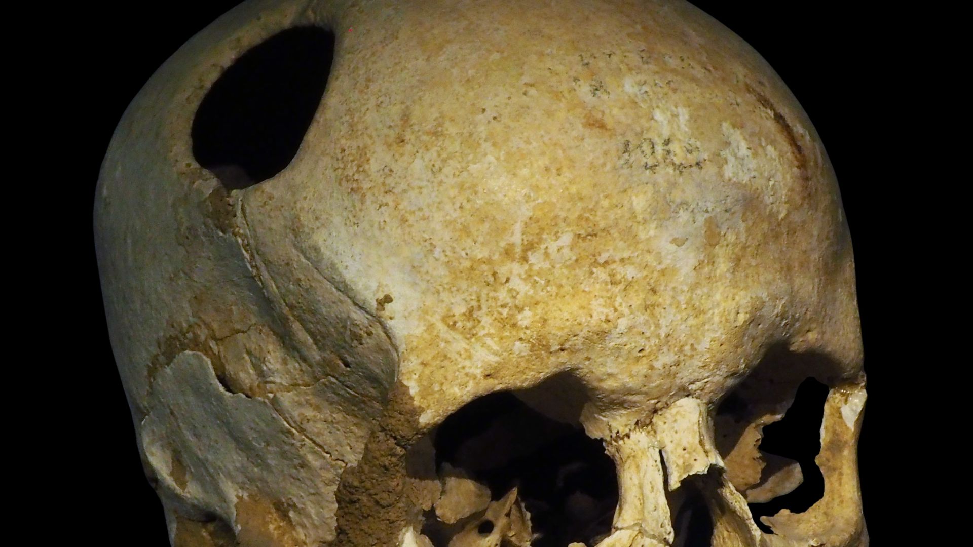 File:Trepanated skull of a woman-P4140363-black.jpg