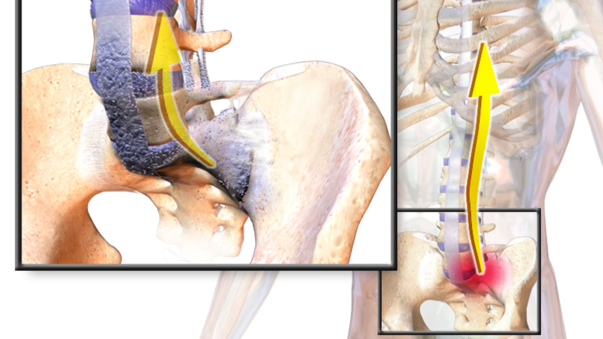 File:Blausen 0037 AnkylosingSpondylitis.png