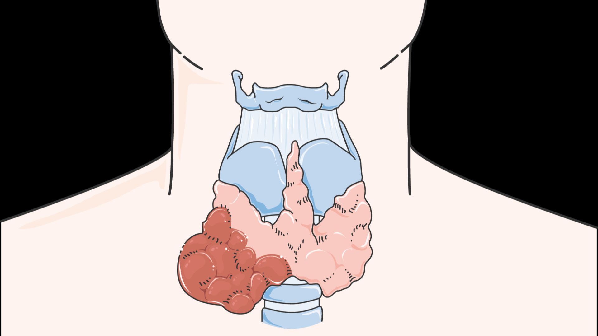 File:Glands - Thyroid cancer 2 -- Smart-Servier.png