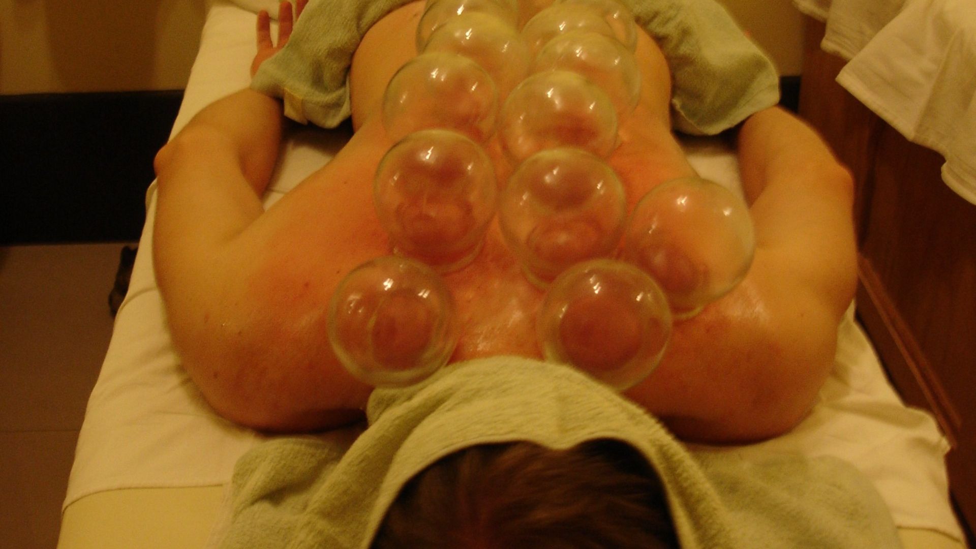 File:Fire Cupping 2008.jpg