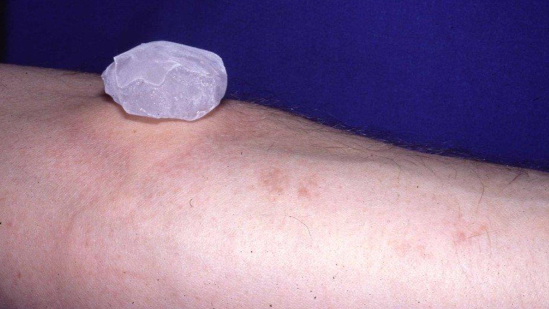 File:Cold urticaria inducible.jpg