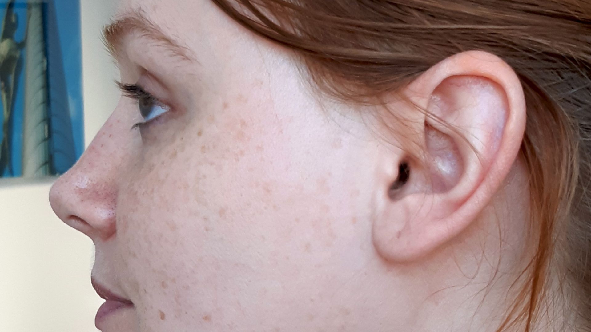 File:Hiperpigmentacija na licu.jpg