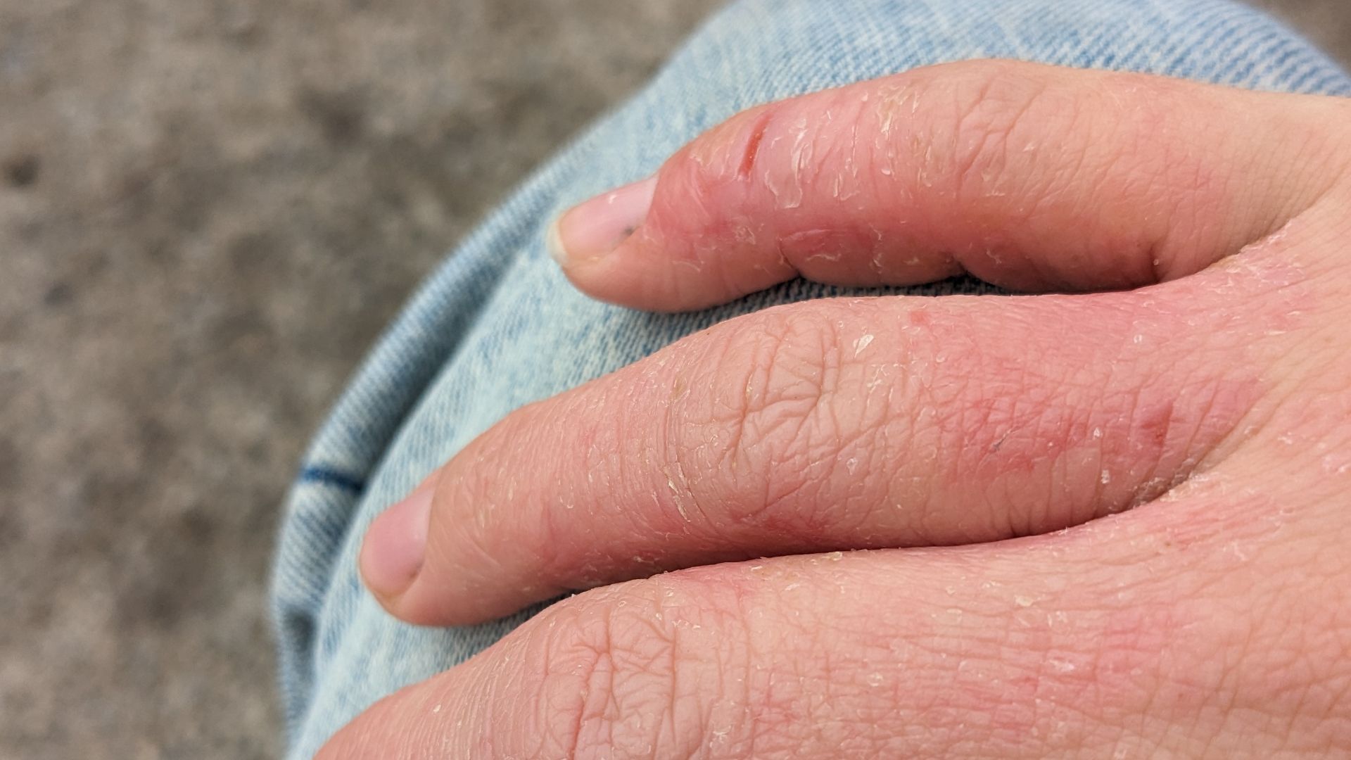 File:Contact dermatitis from dishwashing 2.jpg