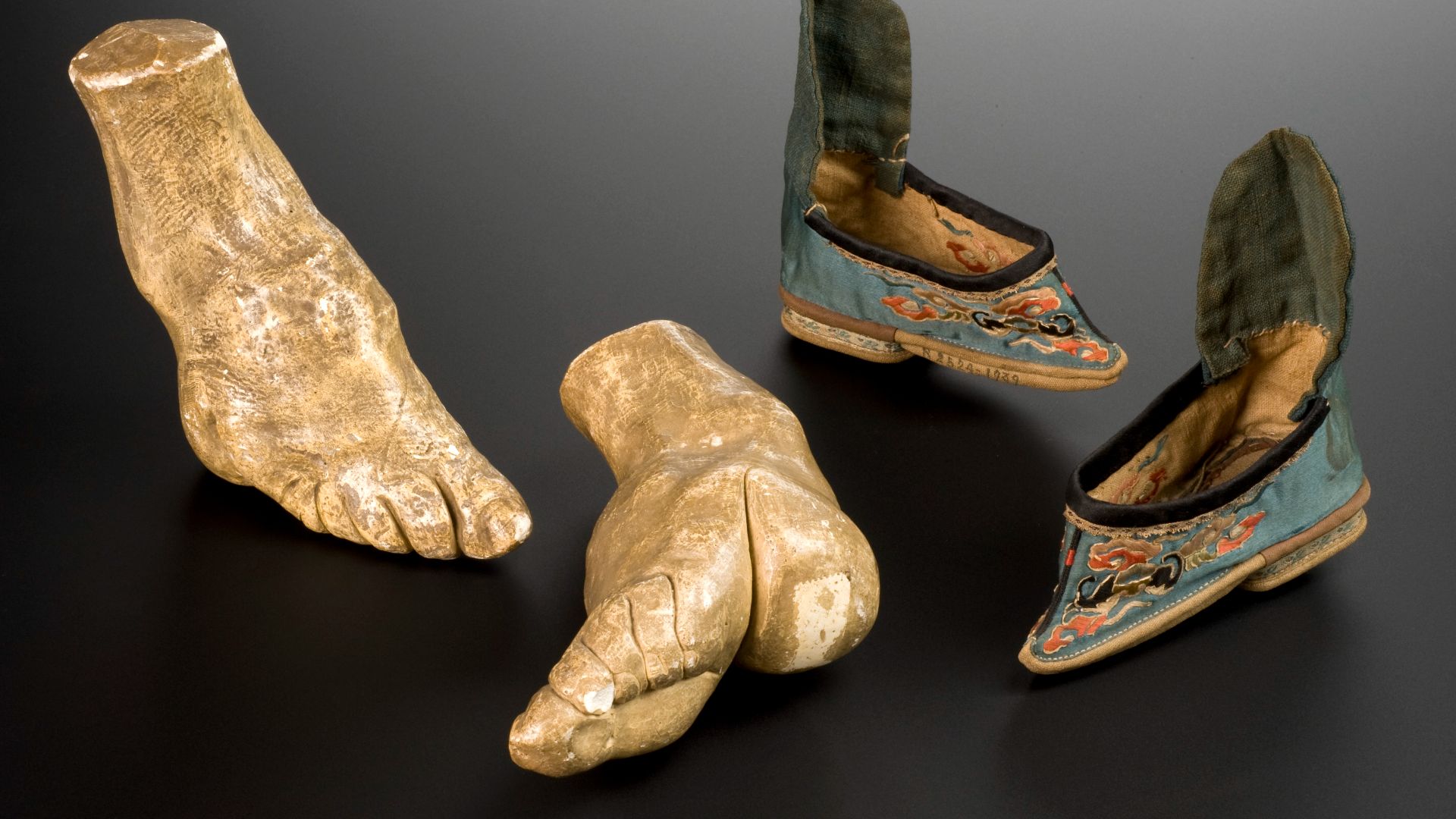 File:Plaster model of left foot deformed by foot-binding Wellcome L0064889.jpg