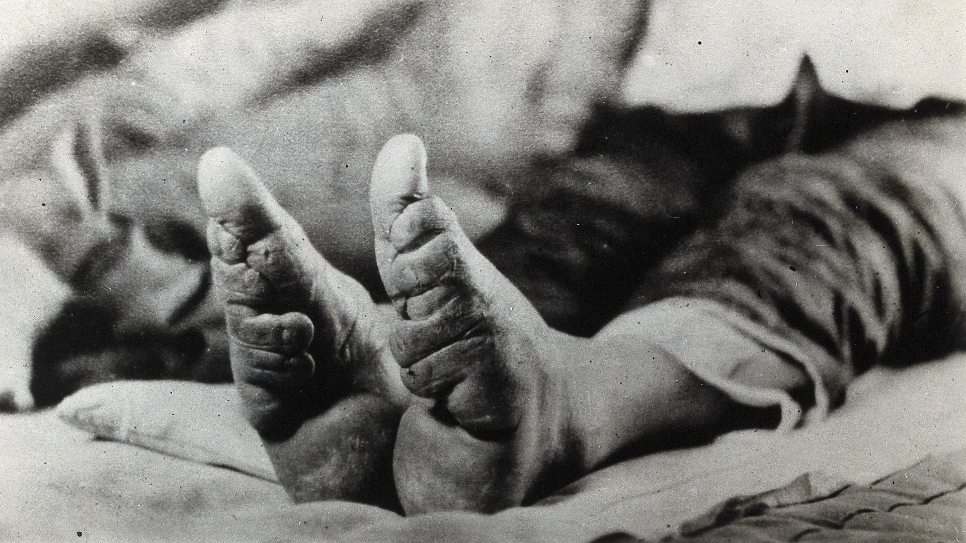 File:Feet of a Chinese woman, showing the effect of foot-binding.jpg