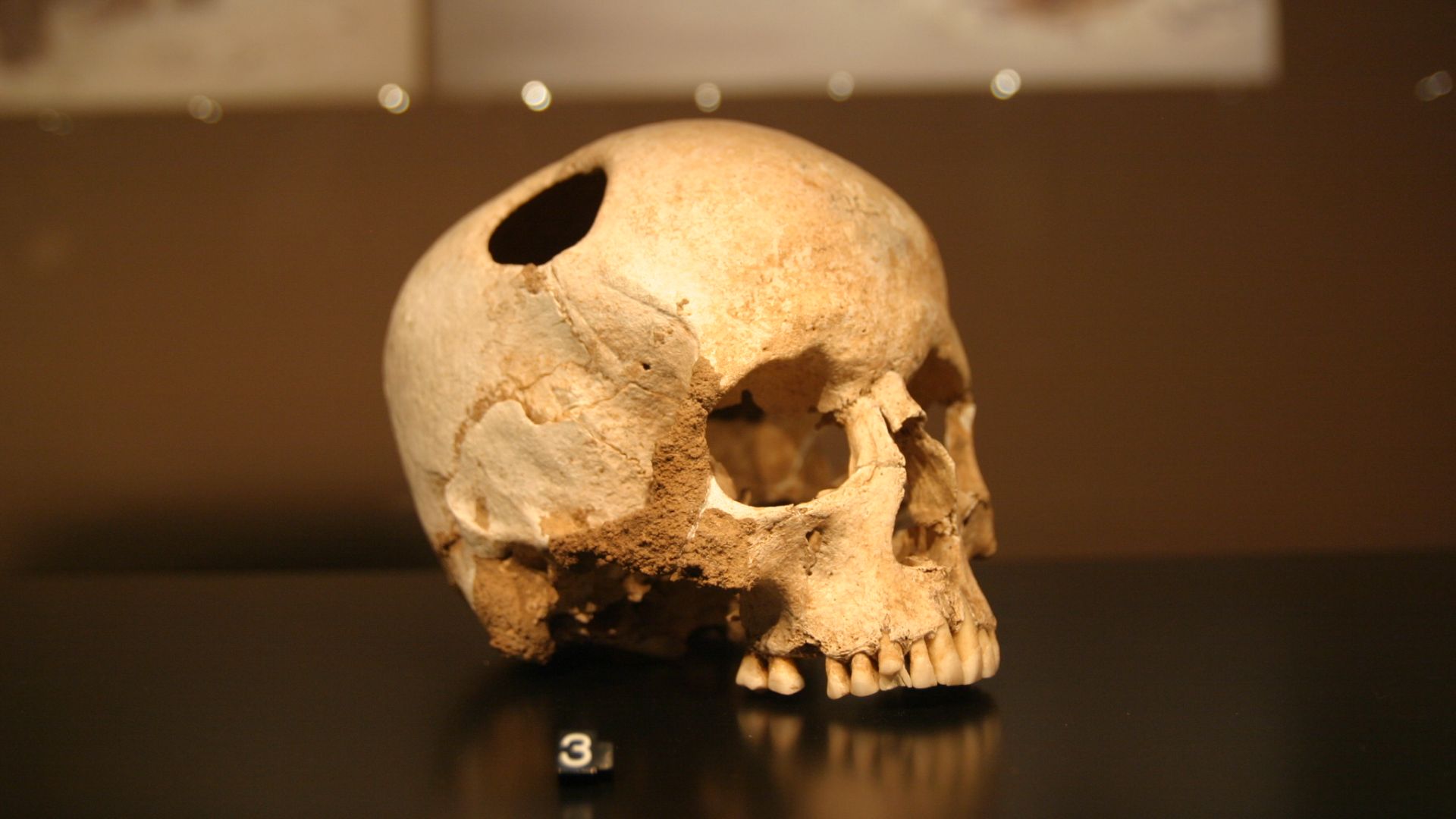 File:Crane-trepanation-img 0507.jpg