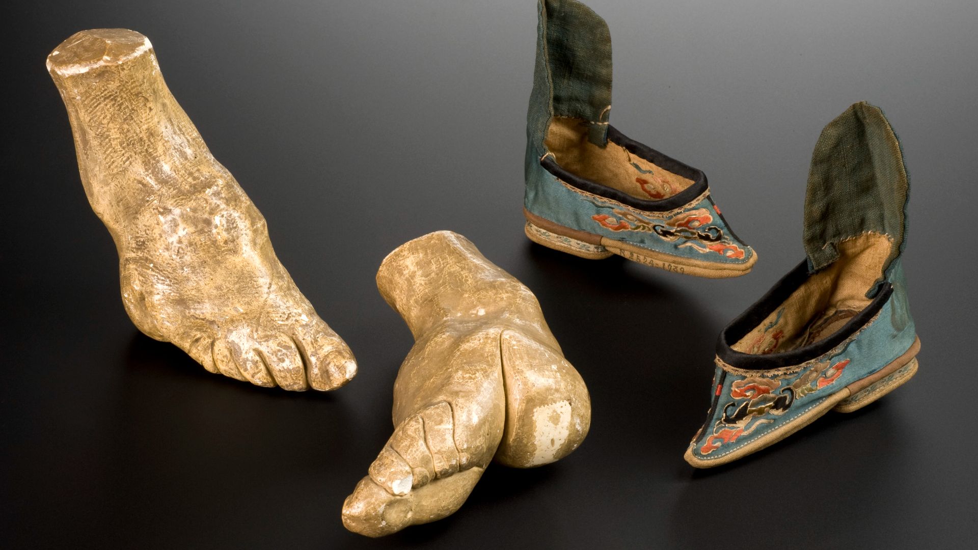 File:Plaster model of left foot deformed by foot-binding Wellcome L0064889.jpg