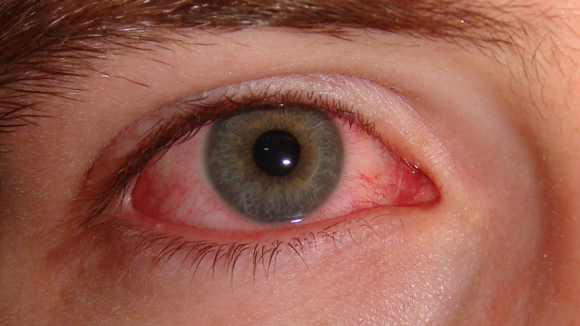 File:Pink eye.jpg