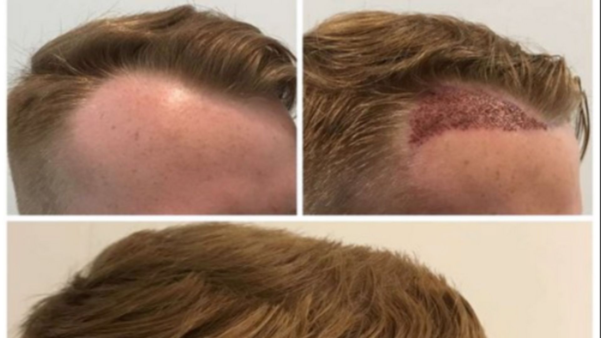 File:Hair Transplant Before and After.png