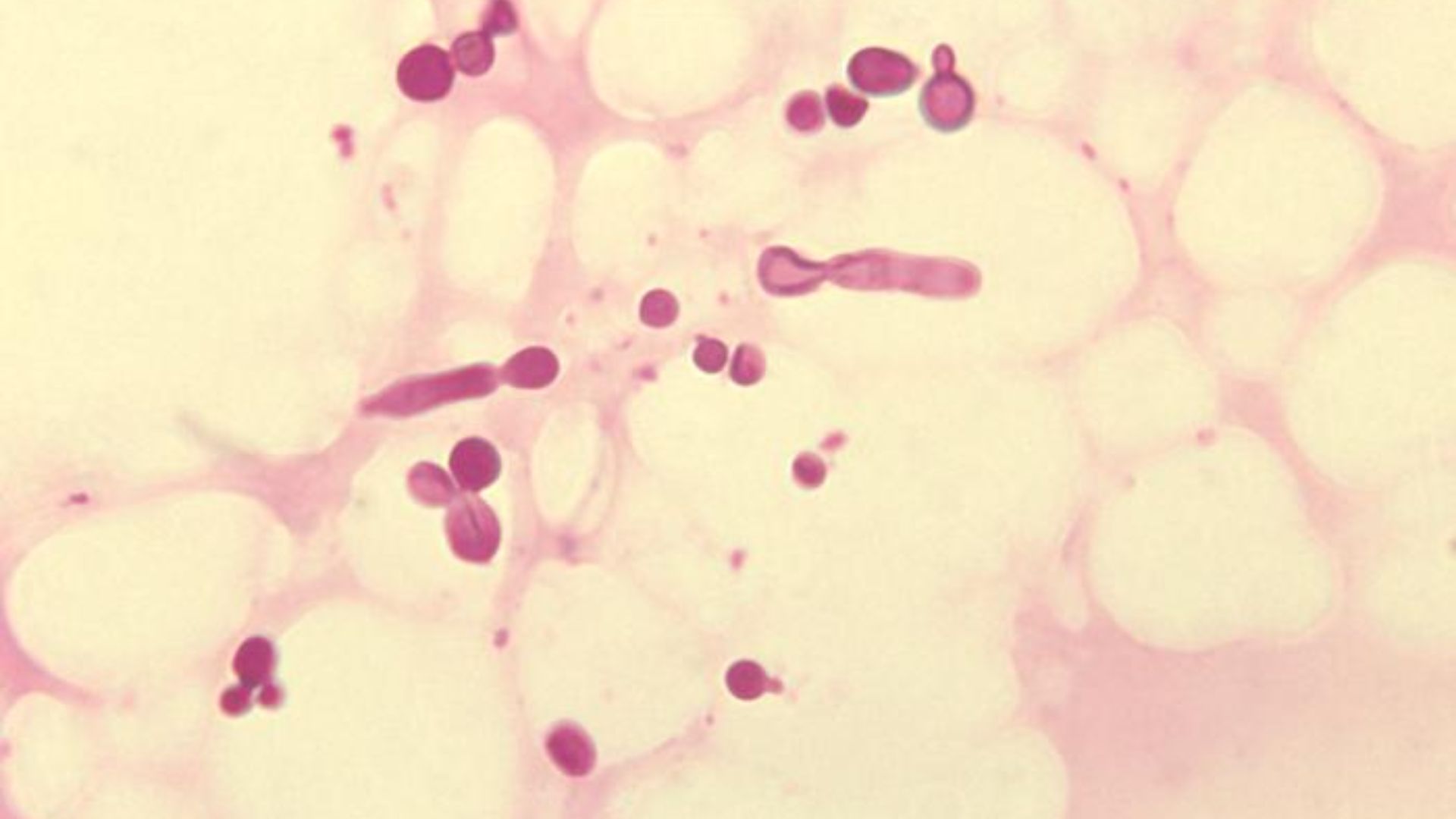File:Malassezia furfur in skin scale from a patient with tinea versicolor PHIL 3938 lores.jpg