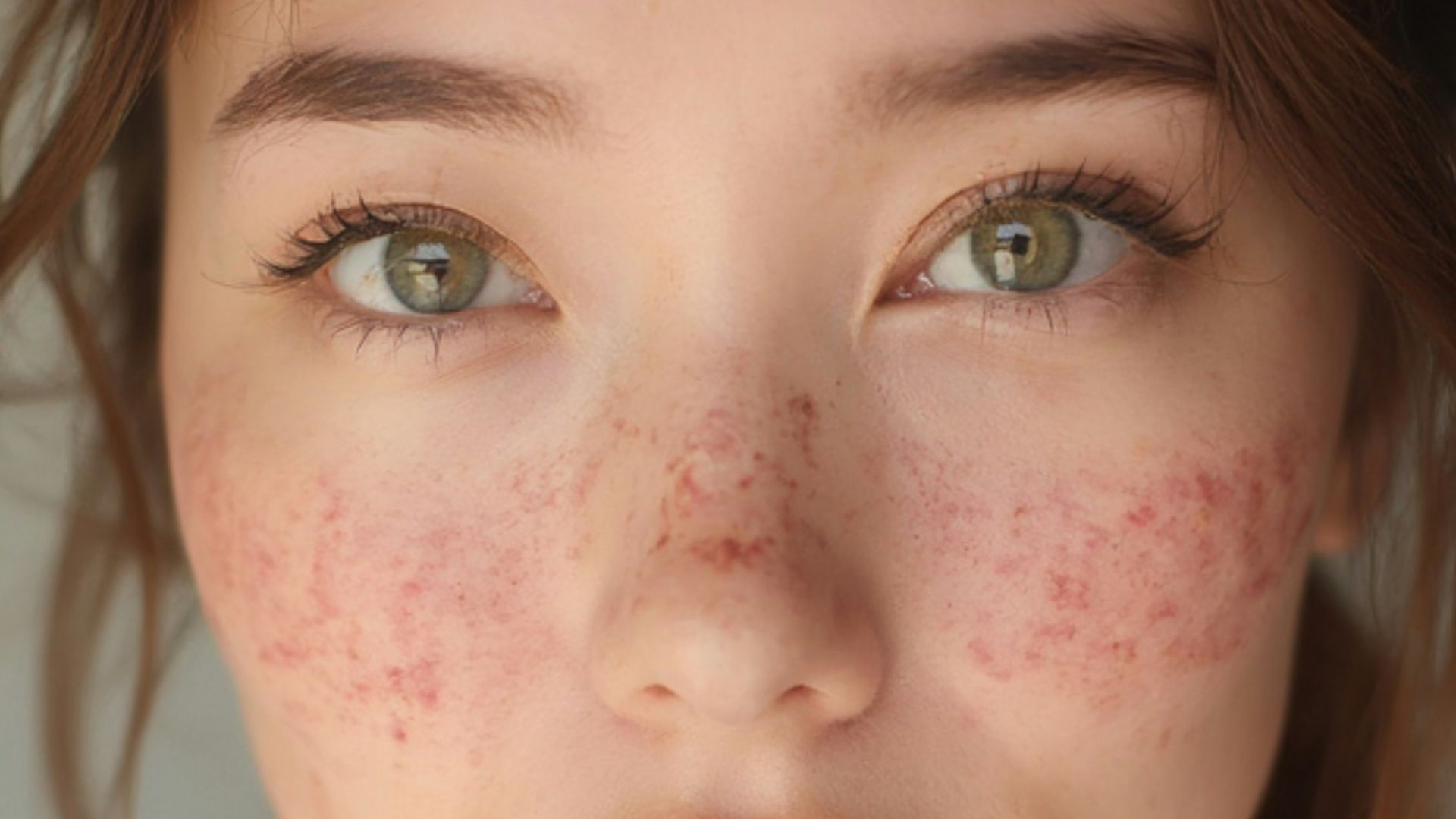 A young woman with freckles on her face