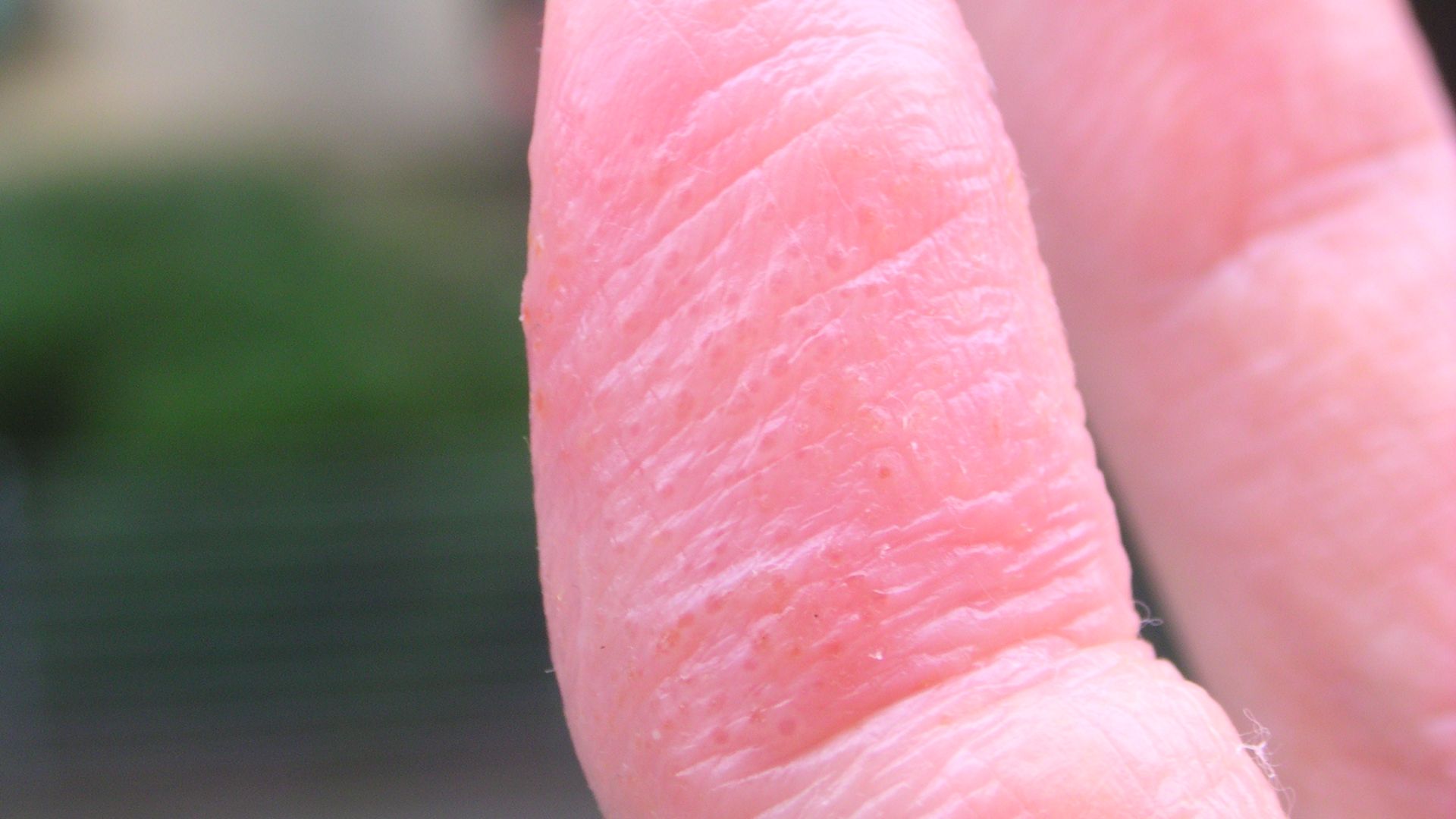 File:Dyshidrosis (2).jpg