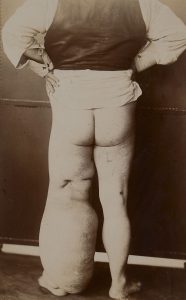 Elephantiasis_of_the_leg_Wellcome_L0062013-186x300.jpg