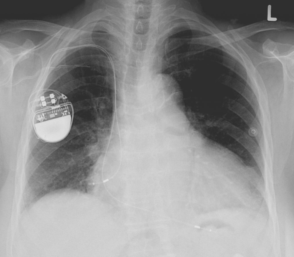 Pacemaker-1024x896.jpg