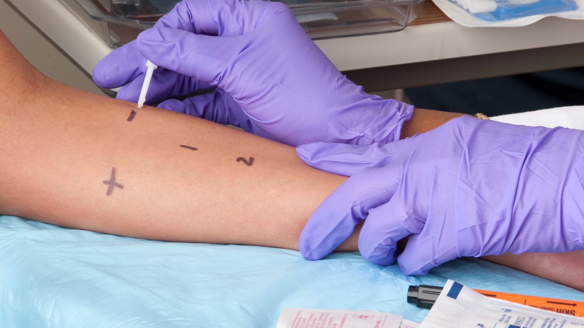File:Skin prick testing for allergies.jpg