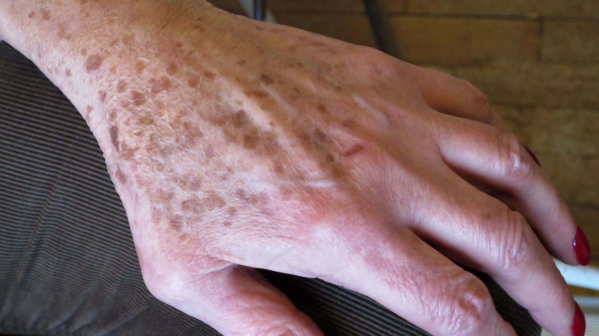 File:Lentigo sénile.jpg