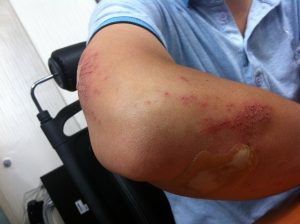 injury-199025_1920-300x224.jpg